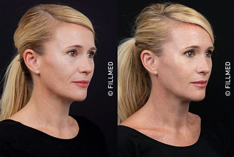 chanel injections|nctf 135ha before and after.